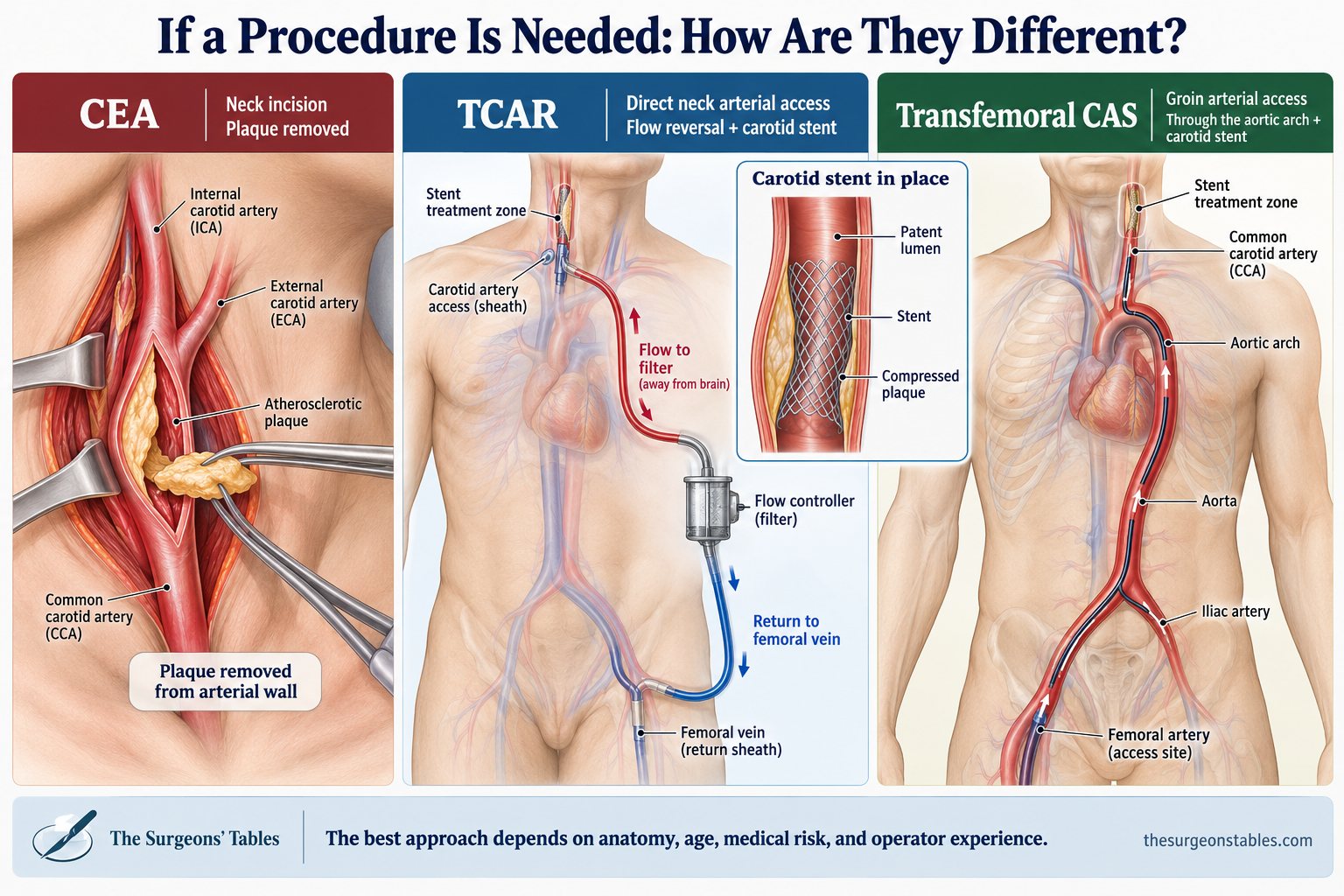 Comparison of carotid endarterectomy, TCAR with direct carotid access and femoral venous return, and transfemoral carotid stenting through the aortic arch.