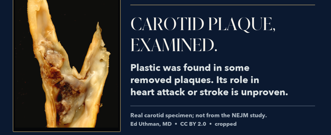Microplastics in Carotid Plaque: Does Finding Them Change What You Should Do?
