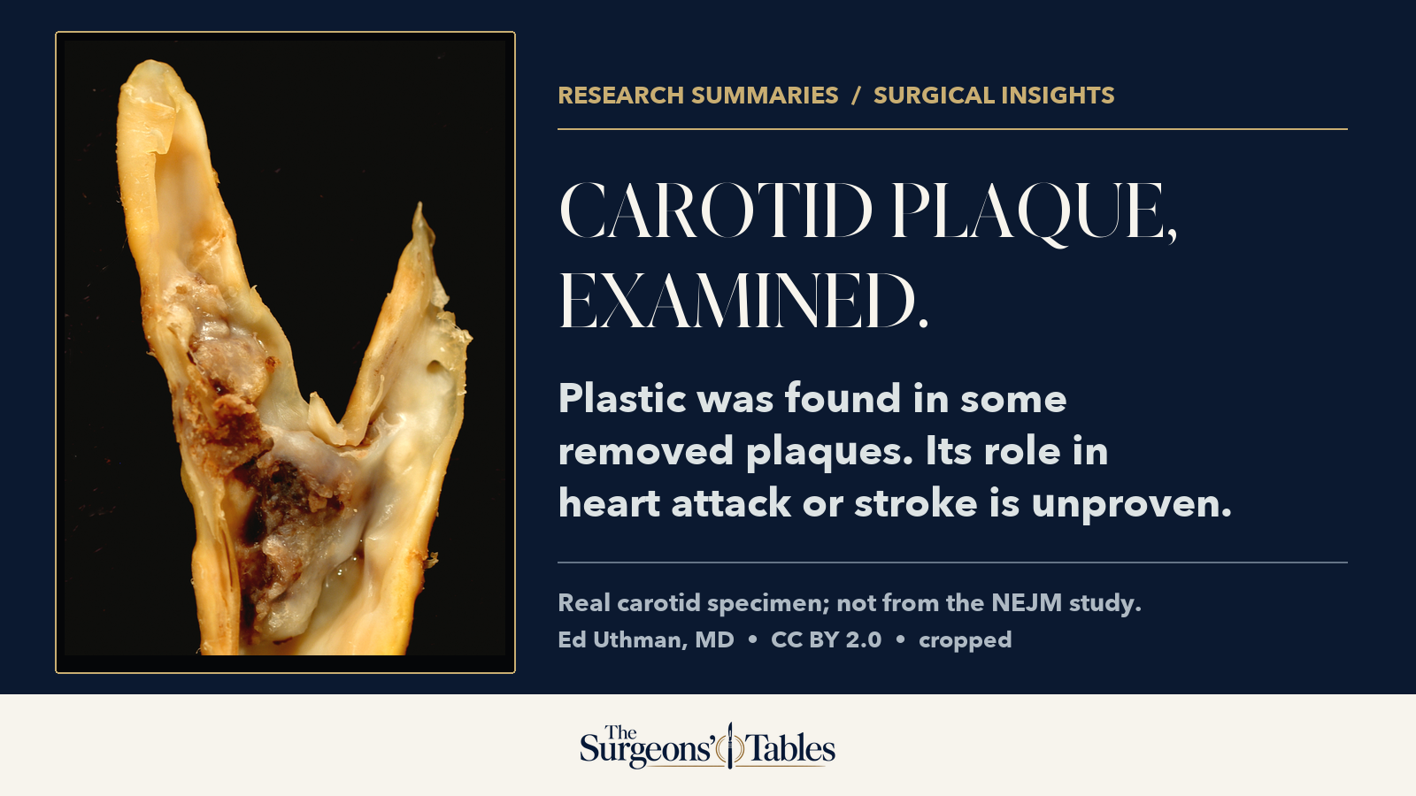 Microplastics in Carotid Plaque: Does Finding Them Change What You Should Do?